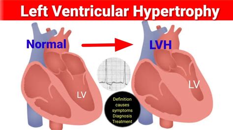 concentric lvh means|mild concentric lvh is dangerous.